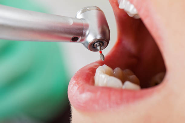 Best Emergency Tooth Extraction in Aliso Viejo, CA